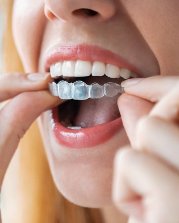 Invisalign® 